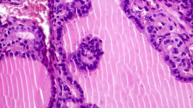 Toxic goitre of the thyroid, light microscopy