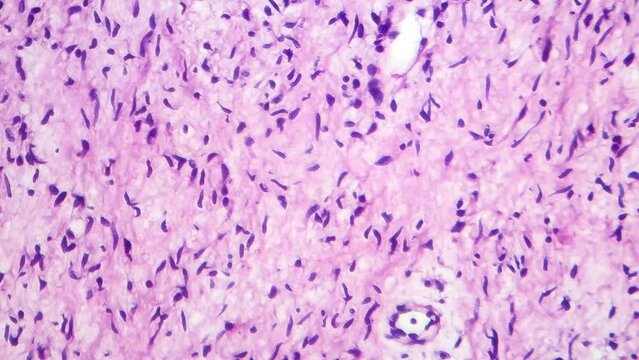 Neurofibromatosis, light microscopy
