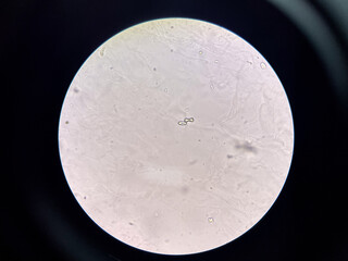 calcium oxalate crystal in urine.