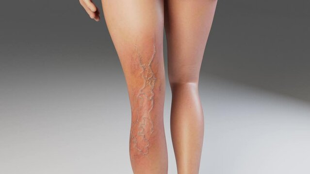 Formation of Varicose Veins on the Calf
