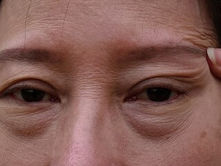 
A middle-aged woman has wrinkles on her face and large bags under her tears.