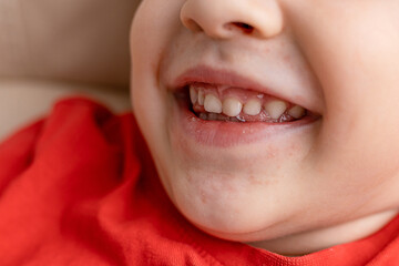 Close-up of a boy's face with red spots near the mouth, atopic dermatitis, allergies, rash and...
