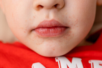Close-up of a boy's face with red spots near the mouth, atopic dermatitis, allergies, rash and...