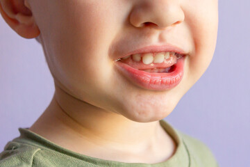 Baby smile close-up. White teeth of a child. Dental kids hygiene background