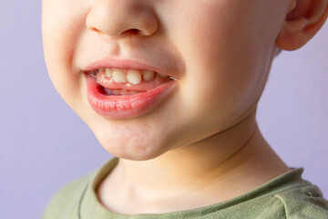 Baby smile close-up. White teeth of a child. Dental kids hygiene background