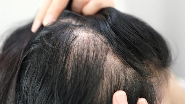 Asian woman parting her hair revealing hair loss or thinning hair.	