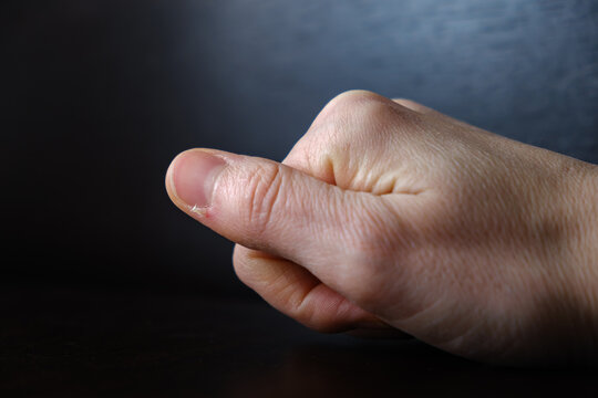 Bleeding hangnail of a female hand on dark background close-up. Ill injury. Ripped off skin. Concept of bad habits, biting and ripping off hangnails on fingernails. High quality photo