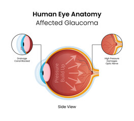 human eye anatomy affected glaucoma