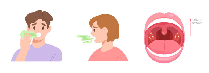 Illustration of and woman have bad breath problem and oral anatomy showing tonsil stone cause of Halitosis. Concept of health care, lifestyle, oral and dental hygiene. Flat vector character.
