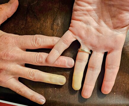 Raynaud's Phenomenon