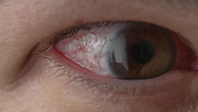 Red eye of an angry man