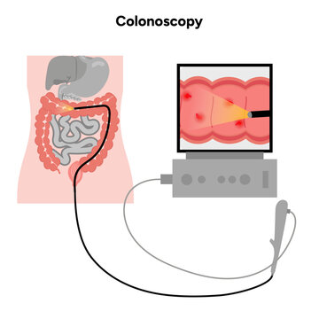 Colonoscopy and colonoscope