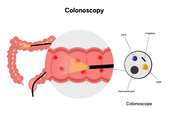Colonoscopy and colonoscope