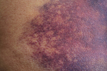 Bruise on the buttock skin injury from accident at home.