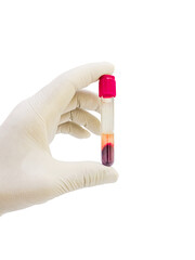 Blood test in the laboratory,The doctor's hands are wearing gloves and holding a clotted blood tube...