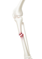 Close-up medical of shin bone fracture Used in medicine for treatment or for advertisements for specialized orthopedic hospitals. Realistic vector illustration.