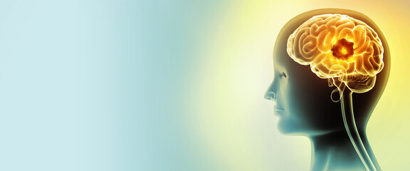 Medically accurate illustration of brain cancer. showing presence of cancerous tumor inside the brain. 3d illustration