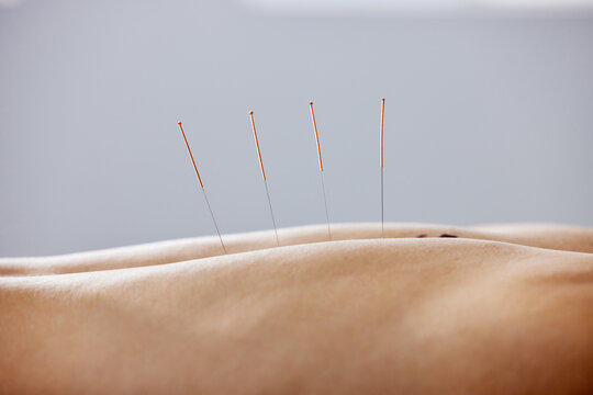 Acupuncture, needles and treatment of body in healthcare, healing muscle and back pain relief. Patient, anatomy and dry needling physiotherapy to relax person at salon and holistic care for injury.