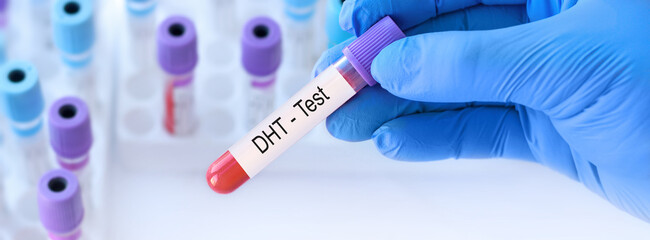 Doctor holding a test blood sample tube with DHT hormone test on the background of medical test...