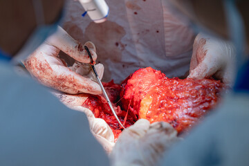 Closeup surgeon in sterile gloves separates flap of skin with fat layer tummy tuck surgery....
