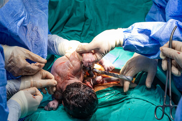 Surgeons performing cesarean section in operating room. Birth surgery with Caesarean. New life,...