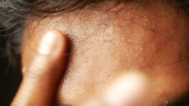 closeup of sweat on forehead against dark background ,