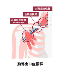 胸郭出口症候群の発生する部位 ベクターイラスト