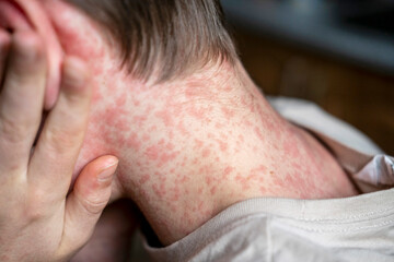 white Teenager covered in measles rash, infectious diseases.