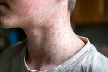 Measles viral disease, human skin covered with measles rash, vaccination concept