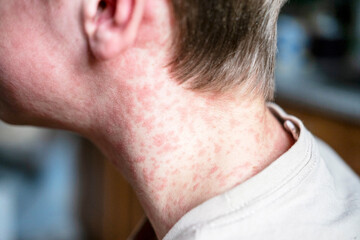 Naklejka premium white Teenager covered in measles rash, infectious diseases.