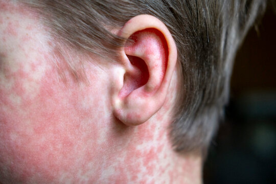 white Teenager covered in measles rash, infectious diseases.