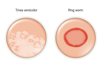 Comparison of Tinea versicolor and Ring worm. Dermatology. Dermatophytosis skin with fungal infection.