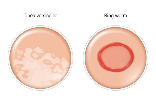 Comparison of Tinea versicolor and Ring worm. Dermatology. Dermatophytosis skin with fungal infection.