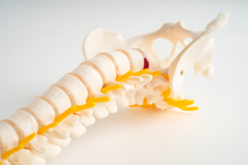 Lumbar spine displaced herniated disc fragment, spinal nerve and bone. Model for treatment medical...
