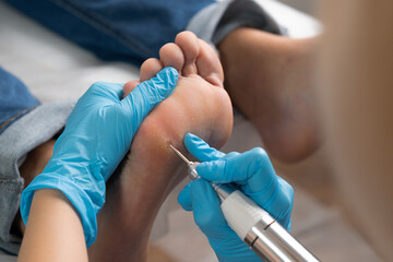 Close up removing a callus on a womans foot by electric drill. 