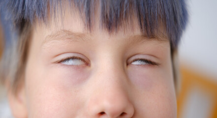 rolled eyes, close up part child face, boy 8 years old, human eye, diagnosis, treatment ophthalmic...