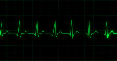 EKG Heartbeat reading animation on black background. Medical monitor displaying cardiography pulse checkup diagnosis electronic screen display machine. Cardiogram nubes rate ecg waveform surgery.