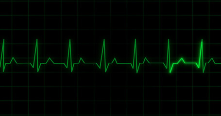EKG Heartbeat reading animation on black background. Medical monitor displaying cardiography pulse checkup diagnosis electronic screen display machine. Cardiogram nubes rate ecg waveform surgery.
