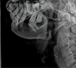 Mandibular Oblique Radiography: Comprehensive Assessment for Diagnostic Clarity.