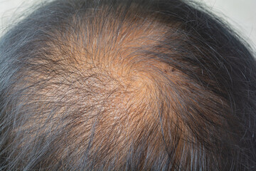 thinning hair in women Scalp problems and treatment No effect on treatment