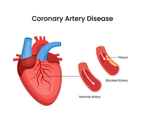 Coronary artery disease medical design