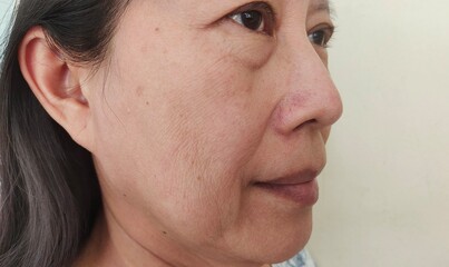 portrait the wrinkle and Flabby skin, Flabbiness and loose beside the eyelid, swelling and ptosis, dark spots and blemish, freckles and ages skin on the face of the woman, health care and beauty.