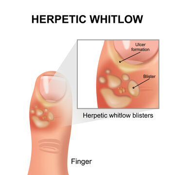 Herpetic whitlow infection in finger illustration