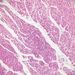 This is a pathological photo of human left ventricular hypertrophy, showing an increase in...