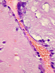 This photo shows the pink mucinous matrix and nest like arrangement of mucinous tumor cells in...