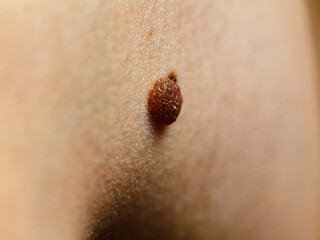 Closeup brown mole on skin.