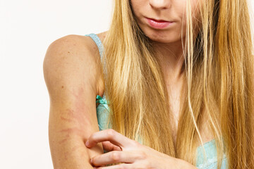 Woman scratching her itchy arm. Skin allergy.