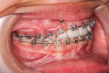 Lateral oblique view of dental arches in biting teeth occlusion, orthodontic braces, elastic O-ring ligature and arch wire. Mini-implants in hyperplasic gingival gum, hyperplasia or hypertrophy. © MSC