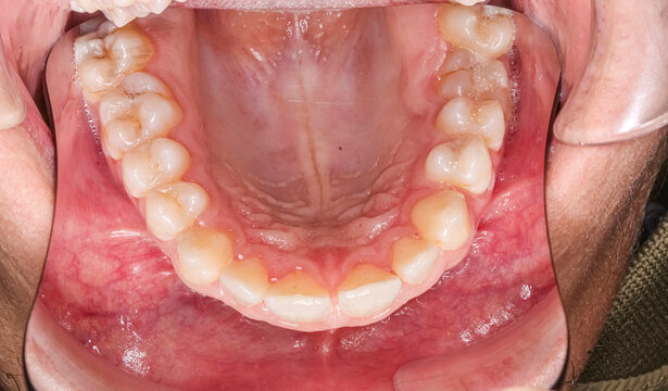 Occlusal view of a maxillary arch, deep palate and gap toothed diastema between central incisors healthy teeth. Indirect view with dental mirror, lips retracted with plastic cheek retractor.