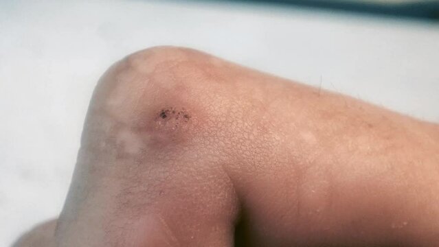 Finger with wart caused by human papillomavirus (HPV).